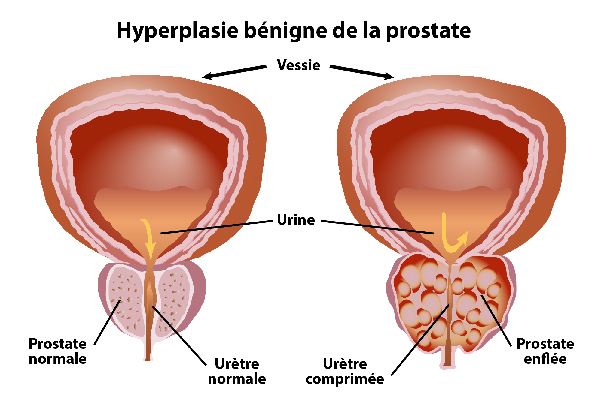 Symptômes courants de l’HBP